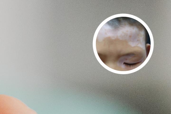 白癜风患者能吃膏方吗