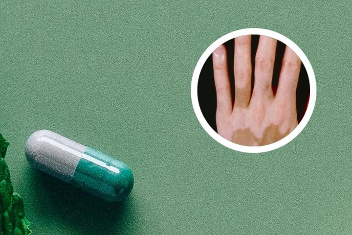白癜风可以涂药膏吗