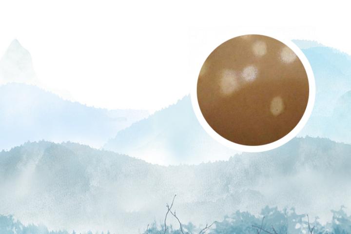 白癜风到那个时期会致死