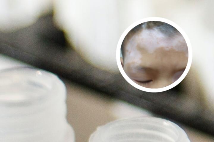 白癜风患者可以吃牡蛎壳吗