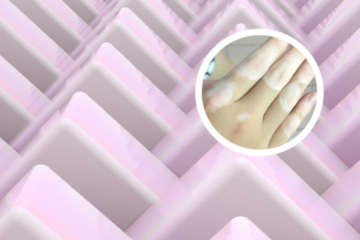 白癜风怕熬夜不