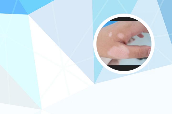 白癜风初期毛发会变白吗