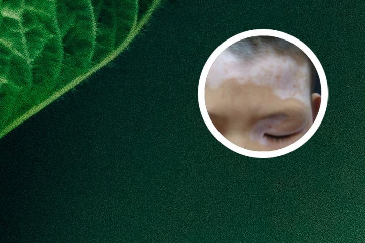 白癜风光疗多久能自愈