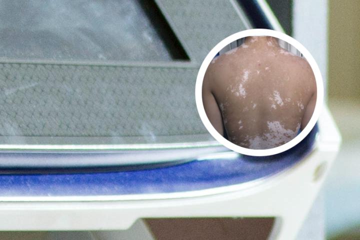 白癜风变成黑色是怎么回事