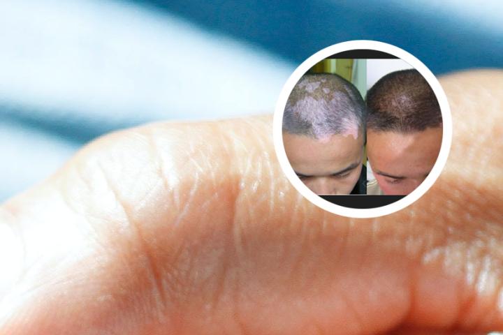 白癜风能进事业单位吗