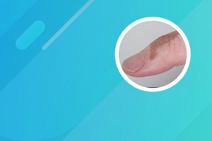 白癜风可以打hpv么