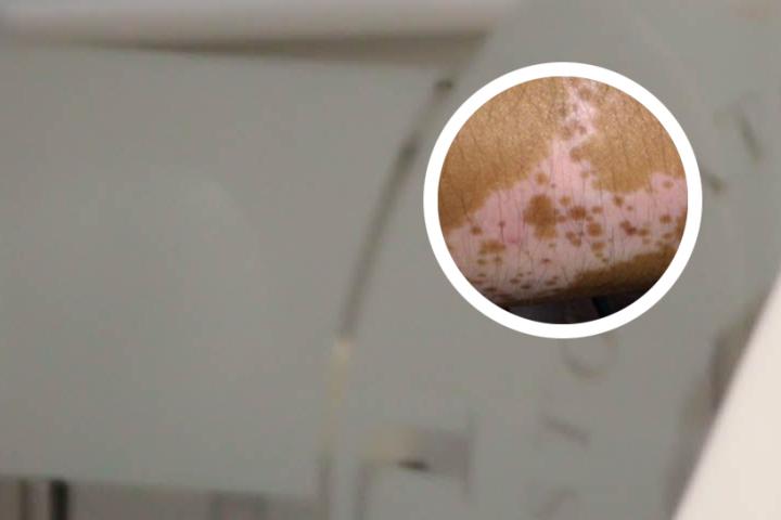 白癜风喝中药能喝黑米酒吗