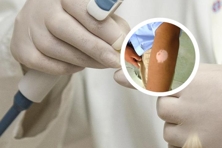 白癜风基本病因