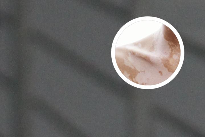 白癜风喝酒有啥影响