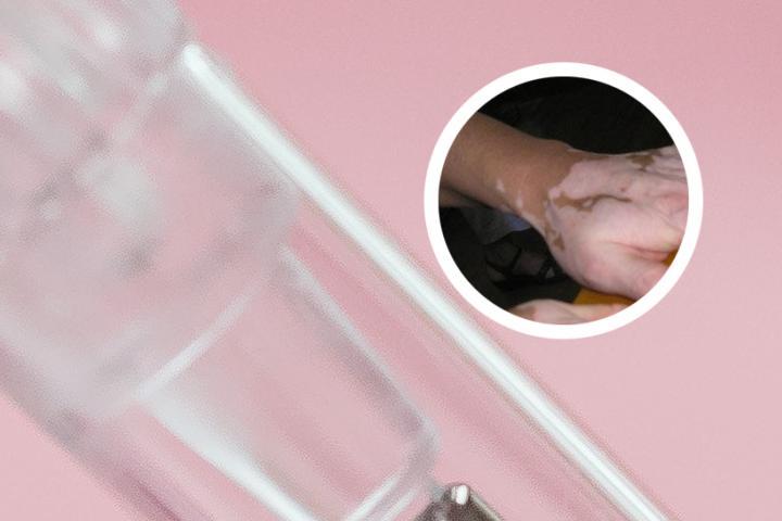 白癜风患者拿的东西能吃吗