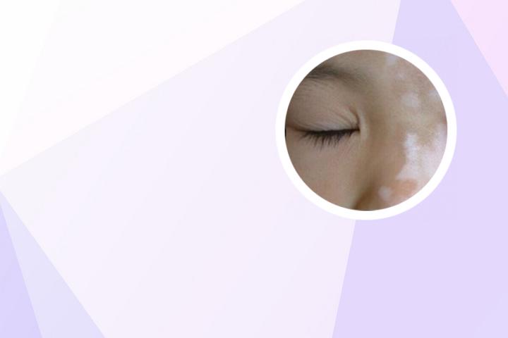 白癜风病人能做狐臭手术吗
