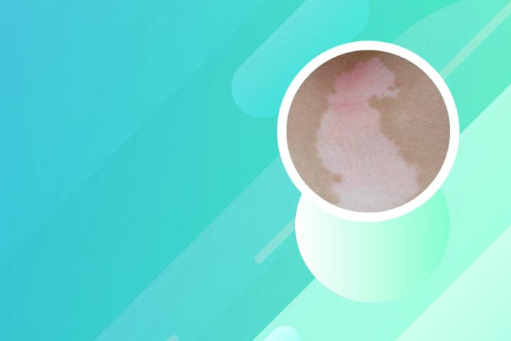 白癜风症状