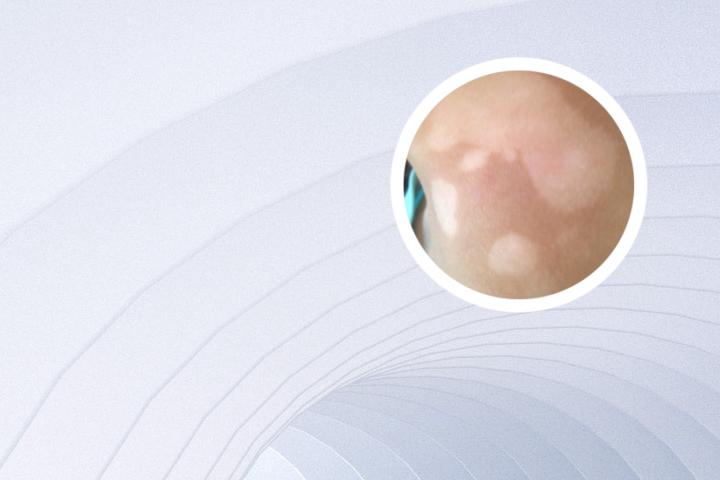 白癜风患者可以吃蟹棒吗
