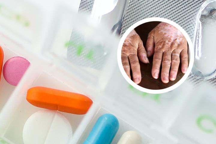 白癜风外敷偏方