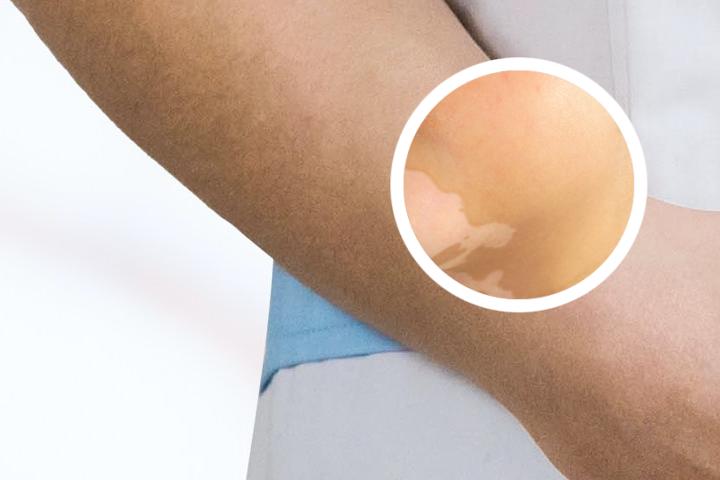 白癜风儿童可以吃哈密瓜吗