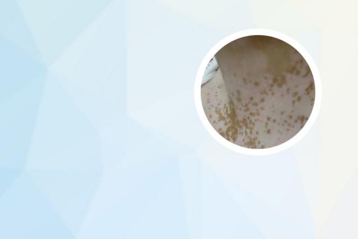 白癜风能大量运动吗