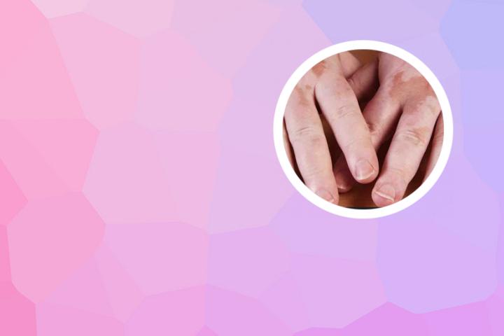 白癜风患者能服用善存吗