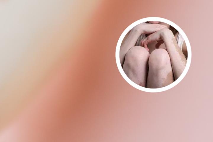 白癜风护肤可以擦凡士林吗
