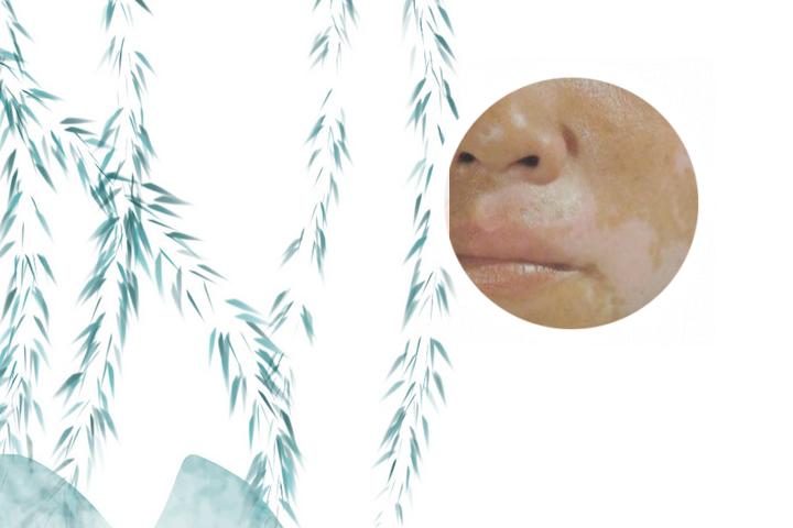 白癜风癌变率有多高