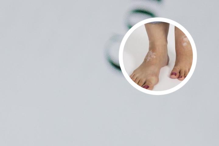白癜风能治愈吗治愈了还会复发吗