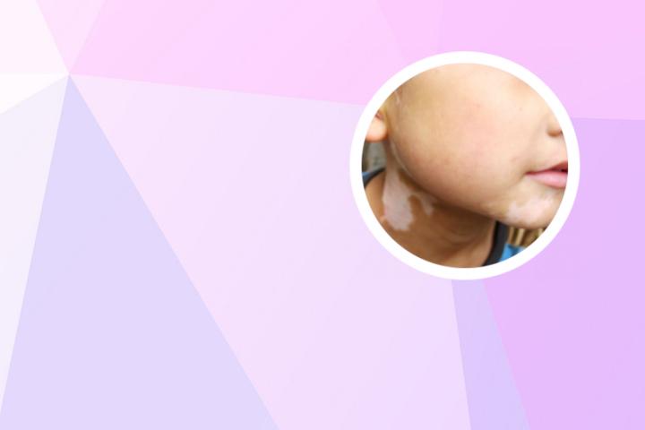 白癜风导入电疗仪作用