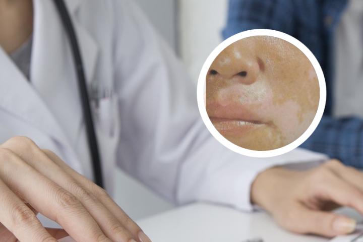 白癜风患者可以吃生蚝吗