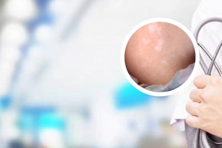 白癜风食物滤镜