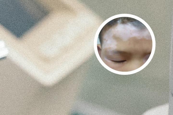 爱出汗的人长白癜风吗