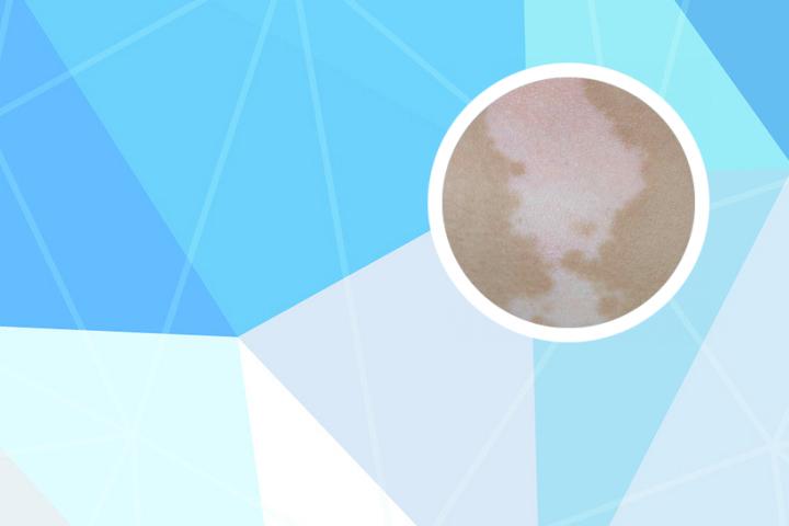 白癜风擦药后变红还是白好