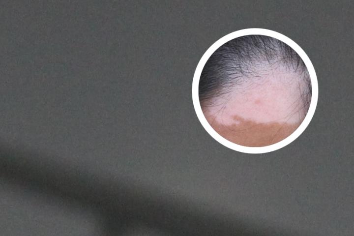 白癜风的初期症状腿部