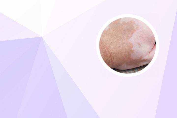 白癜风反复治不好