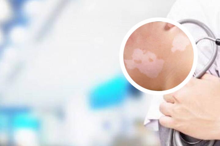 白癜风喝转移因子口服液有帮助吗