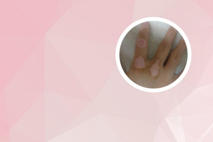 白癜风好了后为什么不能抽烟