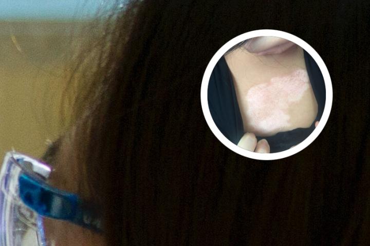 白癜风不易复发