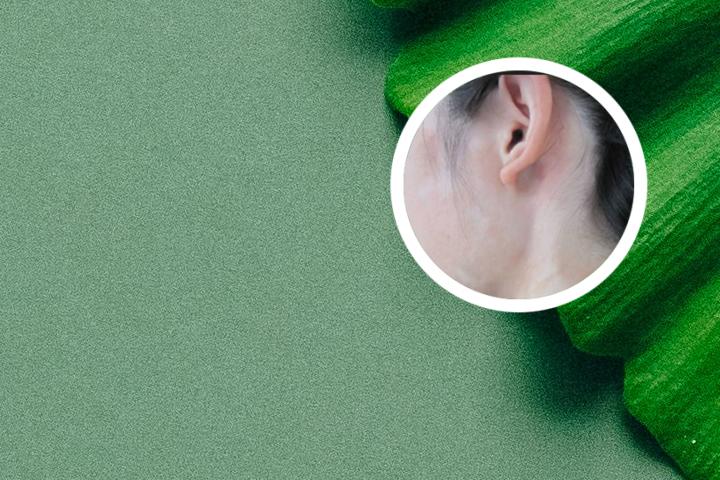 白癜风补铜是什么意思