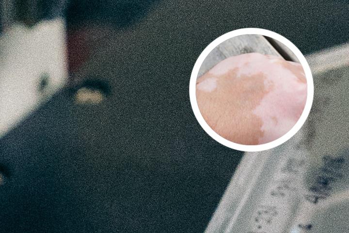 白癜风里出现黑点