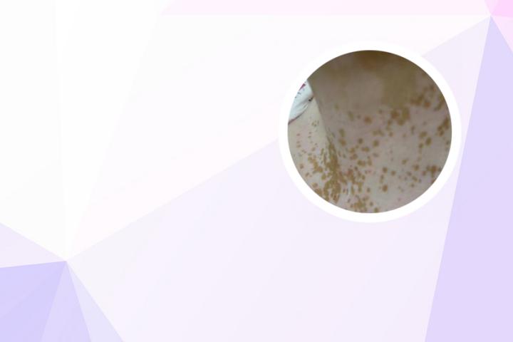 白癜风全白能活多少年