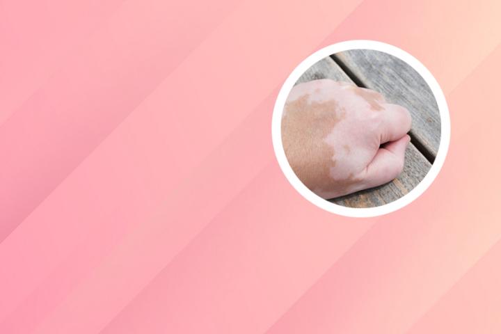 白癜风检测费用多少