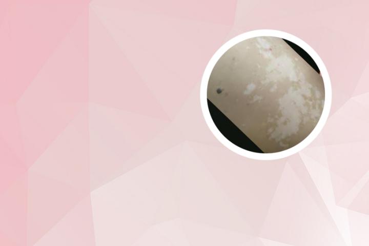 白癜风能喝普洱茶吗