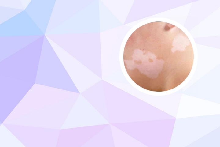 白癜风308照灯面积小