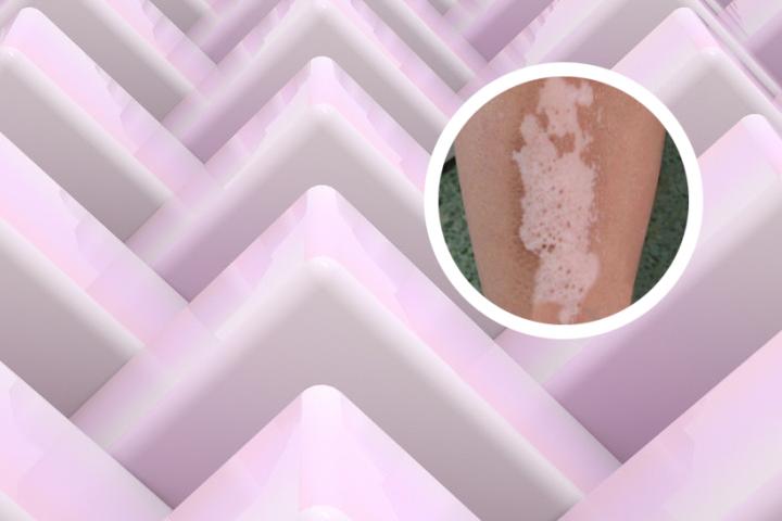 白癜风患者易患癌症