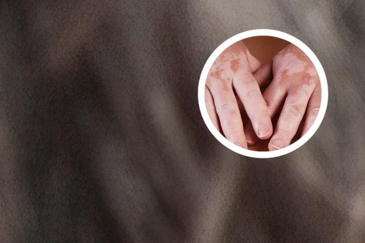白癜风患者容易得甲状腺