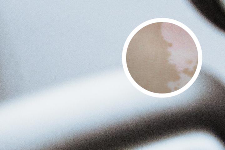 4个月婴儿白癜风的症状