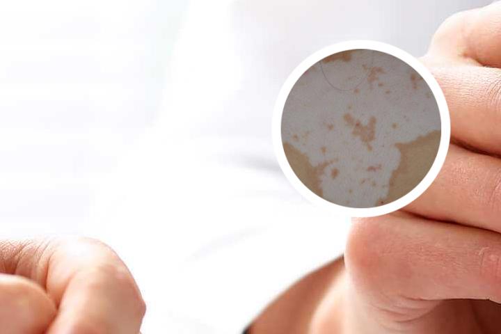 白癜风的治疗是世界难题吗