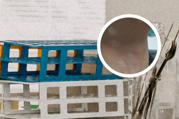 儿童白癜风痒怎么回事