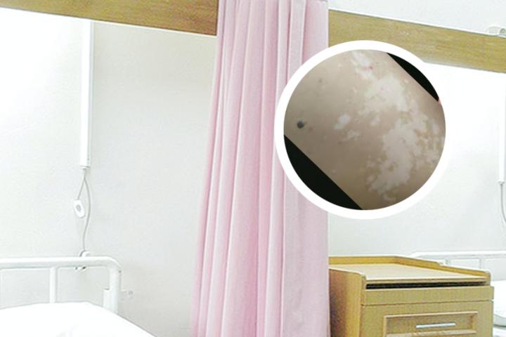 白癜风扩散后怎么恢复