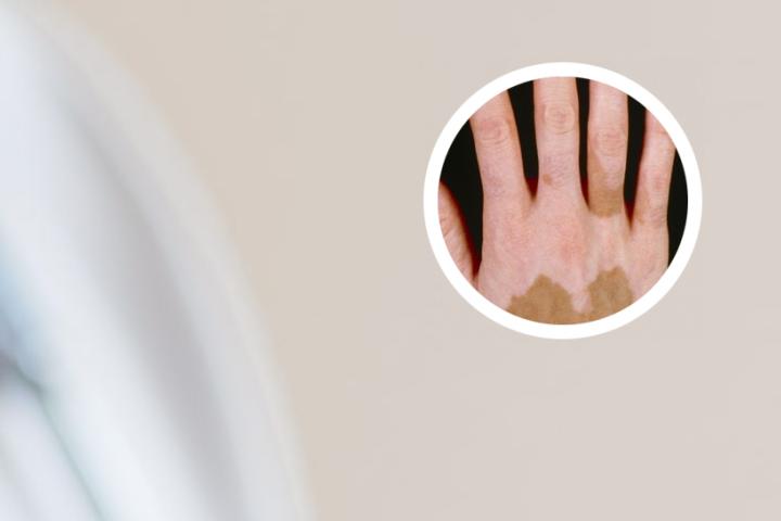 白癜风病人如何治疗