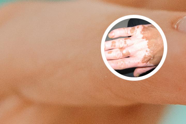 白癜风能不能吃葡萄