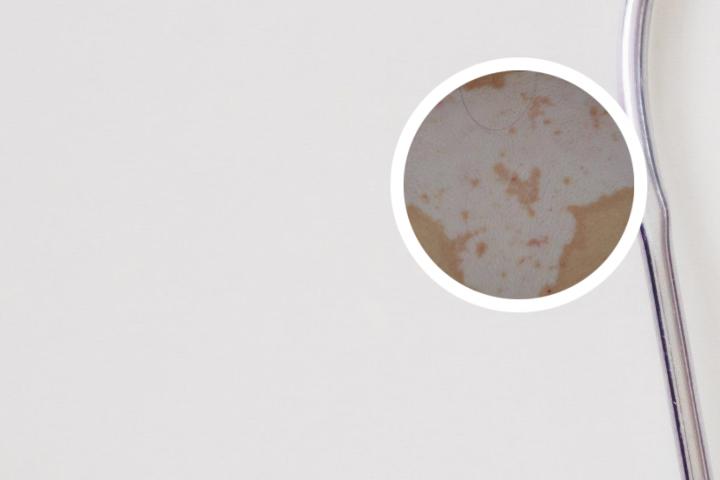 白癜风患者可以吃苦瓜吗