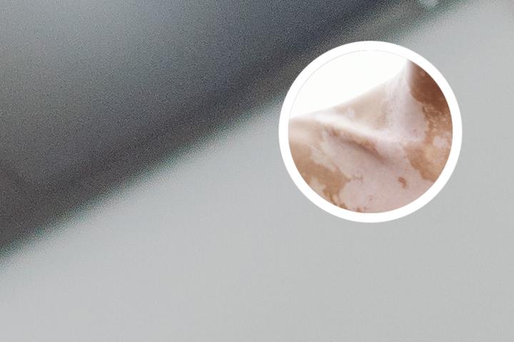 白癜风可以吃干豆角吗